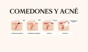 Ilustración explica porque salen puntos negros en la cara: comedón abierto, cerrado, pápula y pústula, mostrando la acumulación de grasa y piel muerta.
