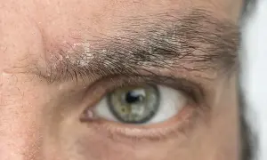 Primer plano de un ojo con caspa en las cejas, mostrando escamas blancas y piel irritada.