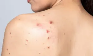 Espalda con acné, mostrando varios granos inflamados sin punta y marcas de curación.
