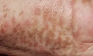Piel con manchas marrones y rosadas, indicativas de hiperpigmentación postinflamatoria.