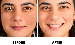 Comparación antes y después de una cara. La piel luce más uniforme y radiante tras el uso de vitaminas.