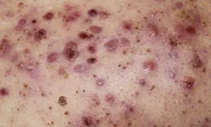 Piel con múltiples pápulas, pústulas y nódulos inflamados, característicos del acne conglobata.
