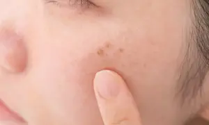 Dedo tocando una mancha en la cara con relieve, mostrando la textura de la piel y las imperfecciones.
