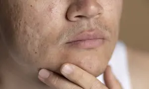 Primer plano de un rostro con marcas de acné. Se muestra la mejilla, la nariz y la boca, con una mano tocando la barbilla. Una guía sobre como quitar marcas de acne.