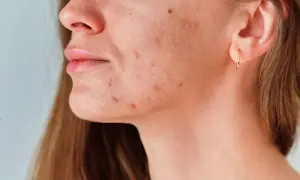 Primer plano de una mujer con granos en el cuello y la mandíbula, mostrando la textura de su piel.