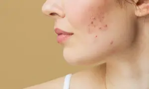 Primer plano de una mejilla con acné. Busca productos no comedogénicos para una piel más sana.