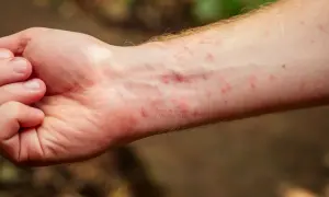 Brazo con erupción roja, posiblemente tiña en la piel, con pequeñas protuberancias y enrojecimiento.