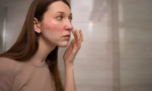 Mujer con sarpullido en la cara, aplicándose crema.