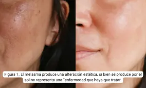Comparación de piel con melasma y piel tratada. El ácido tranexámico puede ayudar a mejorar la apariencia de las manchas.