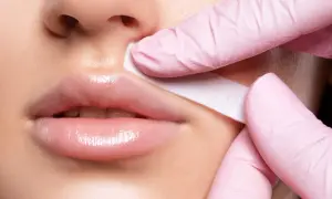 Manos enguantadas retiran banda de cera del labio superior, tratando el melasma bigote.