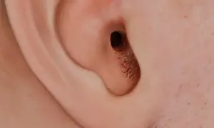 Detalle del canal auditivo de una oreja, mostrando un punto negro y acumulación de cera.