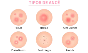 Ilustración de varios tipos de acné: pápula, nódulo, acné quístico, punto blanco, punto negro y pústula.