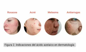 Indicaciones del ácido azelaico: rosácea, acné, melasma y antiarrugas.