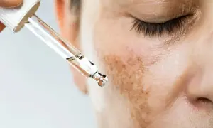 Gotas de suero para tratar el melasma que es, manchas oscuras en la piel.
