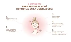 Cinco consejos para tratar el acné hormonal en mujeres adultas: identificar causas, usar cosméticos específicos, actuar sobre el estilo de vida, aplicar tratamientos tópicos y sistémicos.