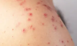 Primer plano de piel con múltiples ronchas rojas, algunas con pequeños puntos blancos, indicando una posible irritación o reacción cutánea.