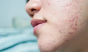 Primer plano de la mejilla de una persona mostrando marcas de acné por estrés, con granos rojos e inflamados.