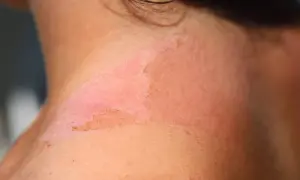 Piel enrojecida y descamada en el cuello, indicativo de un eritema solar severo tras una exposición prolongada al sol.