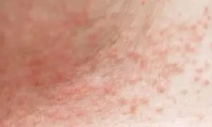 Piel con erupción de pequeños granos rojos, posiblemente por sudor.
