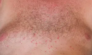 Pequeños bultos rojos cubren el pecho de un hombre, indicando un sarpullido por calor.