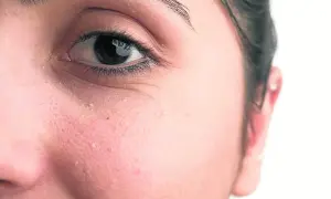 Primer plano del ojo y mejilla de una persona con pequeños quistes de milium blancos visibles en la piel.