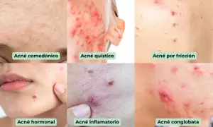 Primer plano de diferentes tipos de acné, incluyendo acné en la frente, quístico, por fricción, hormonal, inflamatorio y   conglobata.