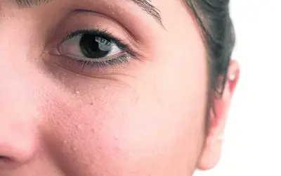 Primer plano del ojo y mejilla de una persona con pequeños quistes de milium blancos visibles en la piel.