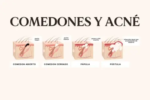 Ilustración explica porque salen puntos negros en la cara: comedón abierto, cerrado, pápula y pústula, mostrando la acumulación de grasa y piel muerta.