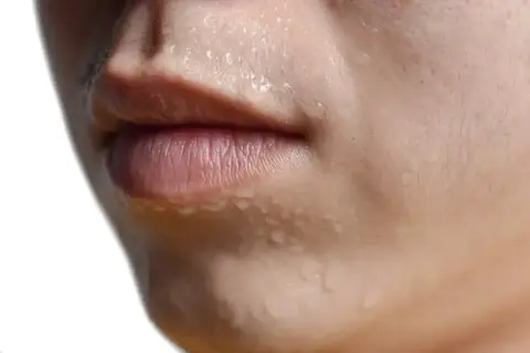 Primer plano de un rostro con gotas de sudor, evidencia de hiperhidrosis facial.