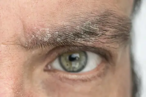 Primer plano de un ojo con caspa en las cejas, mostrando escamas blancas y piel irritada.