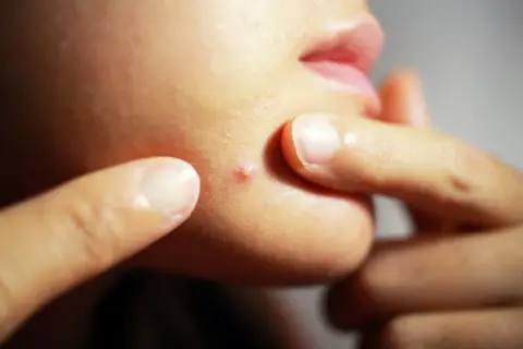 Dedos apuntan a un grano rojo en la barbilla. ¿Buscas como quitar un grano rápido?