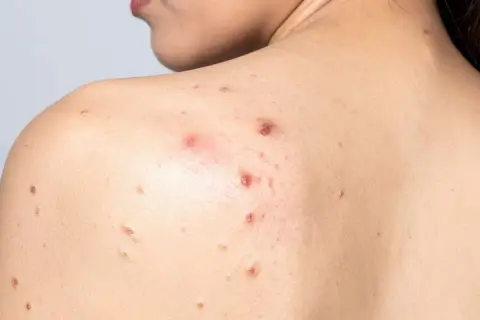 Espalda con acné, mostrando varios granos inflamados sin punta y marcas de curación.