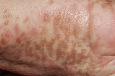 Piel con manchas marrones y rosadas, indicativas de hiperpigmentación postinflamatoria.