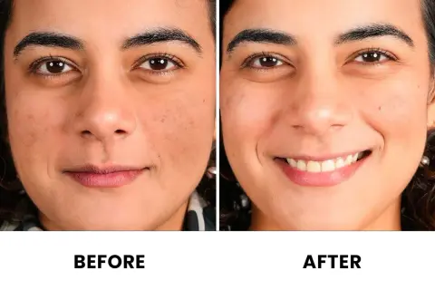 Comparación antes y después de una cara. La piel luce más uniforme y radiante tras el uso de vitaminas.