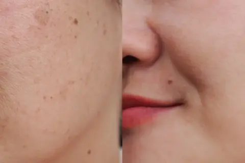 Comparación antes y después de un tratamiento para eliminar manchas de la cara. La piel luce más uniforme y radiante.