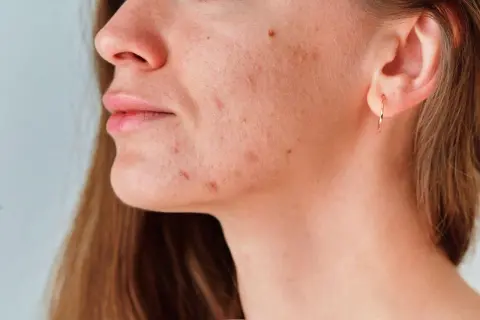 Primer plano de una mujer con granos en el cuello y la mandíbula, mostrando la textura de su piel.