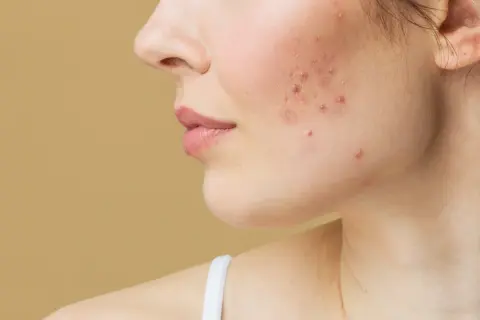Primer plano de una mejilla con acné. Busca productos no comedogénicos para una piel más sana.