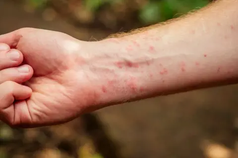 Brazo con erupción roja, posiblemente tiña en la piel, con pequeñas protuberancias y enrojecimiento.