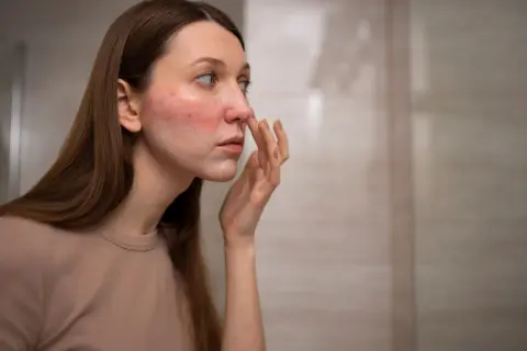 Mujer con sarpullido en la cara, aplicándose crema.