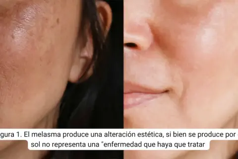 Comparación de piel con melasma y piel tratada. El ácido tranexámico puede ayudar a mejorar la apariencia de las manchas.