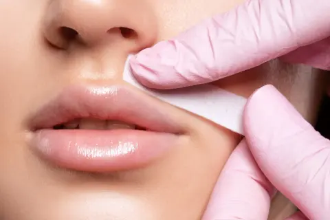 Manos enguantadas retiran banda de cera del labio superior, tratando el melasma bigote.