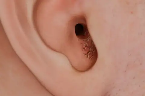 Detalle del canal auditivo de una oreja, mostrando un punto negro y acumulación de cera.