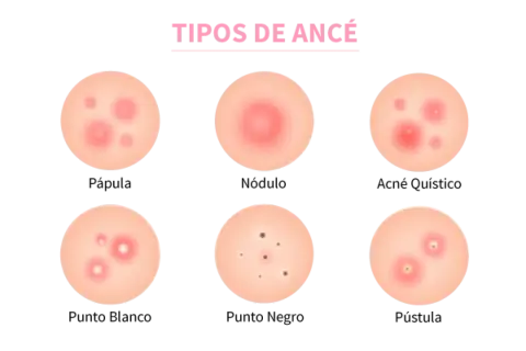 Ilustración de varios tipos de acné: pápula, nódulo, acné quístico, punto blanco, punto negro y pústula.