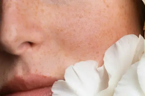 Piel con pecas y pétalos blancos. Las ceramidas para que sirve: restauran la barrera cutánea, hidratan y protegen.