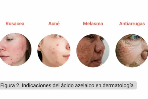Indicaciones del ácido azelaico: rosácea, acné, melasma y antiarrugas.