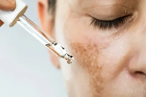 Gotas de suero para tratar el melasma que es, manchas oscuras en la piel.