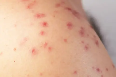 Primer plano de piel con múltiples ronchas rojas, algunas con pequeños puntos blancos, indicando una posible irritación o reacción cutánea.