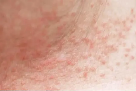 Piel con erupción de pequeños granos rojos, posiblemente por sudor.
