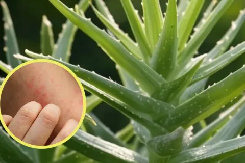 Primer plano de una planta de aloe vera con un círculo que muestra una piel irritada y enrojecida, sugiriendo contraindicaciones del aloe vera en la piel.