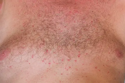 Pequeños bultos rojos cubren el pecho de un hombre, indicando un sarpullido por calor.